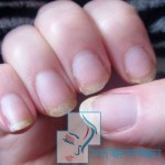 ভঙ্গুর নখের সমাধান সহজ ২ টি উপায়ে