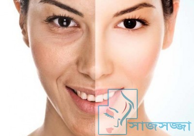 বলিরেখা দূর