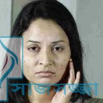 ”ত্বকের যত্ন” মুখের যেকোনো দাগ দূর করার সহজ ঘরোয়া উপায়